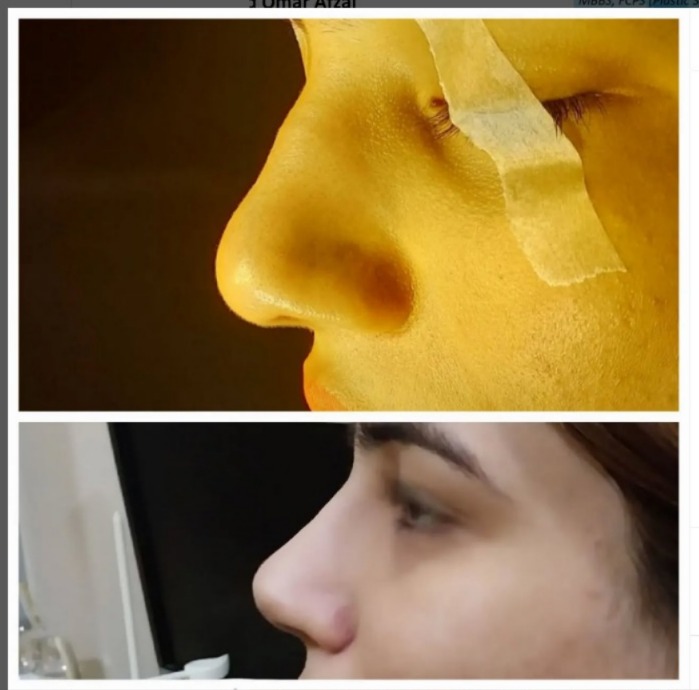nose job