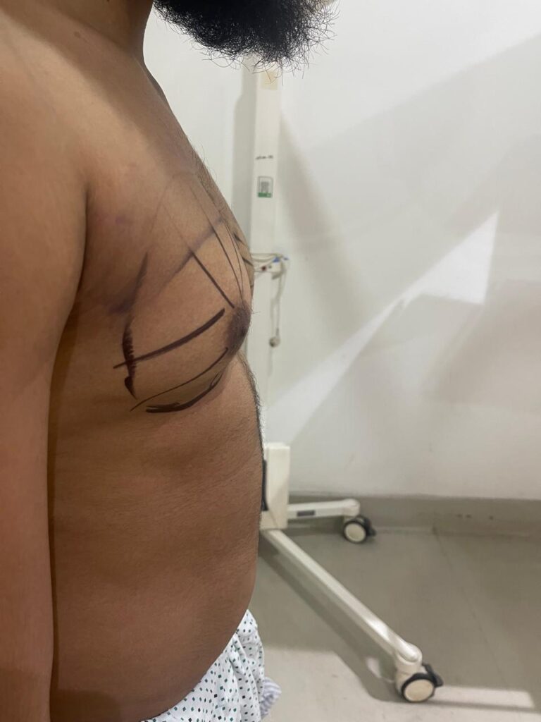 liposuction